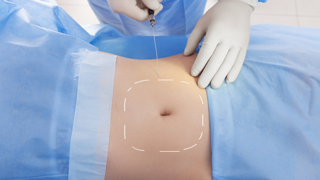 What to Anticipate Before and During A Liposuction Surgery Process