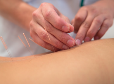 Dry Needling Therapy: What Is It?