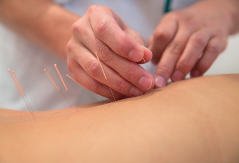 Dry Needling Therapy: What Is It?