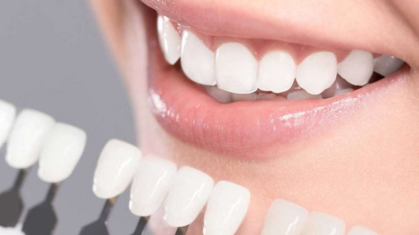 7 Reasons Why Porcelain Veneers Fail