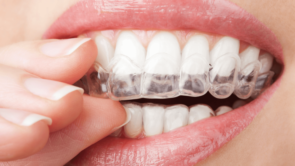 Care and Cleaning of your Invisalign Trays