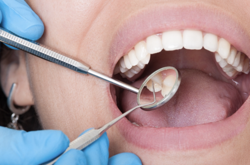 What Should You Do When You Suspect a Cracked Tooth?