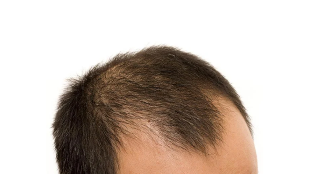 Genetics Strike Early? Understanding Early-Onset Hair Loss in Men