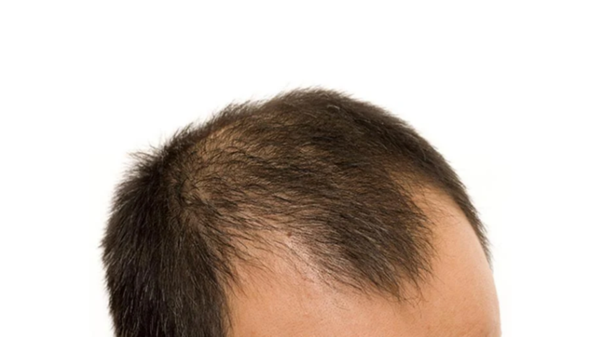 Strike Early? Understanding EarlyOnset Hair Loss in Men