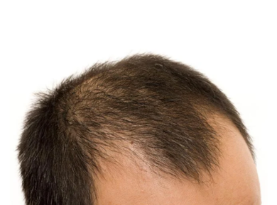 Genetics Strike Early? Understanding Early-Onset Hair Loss in Men