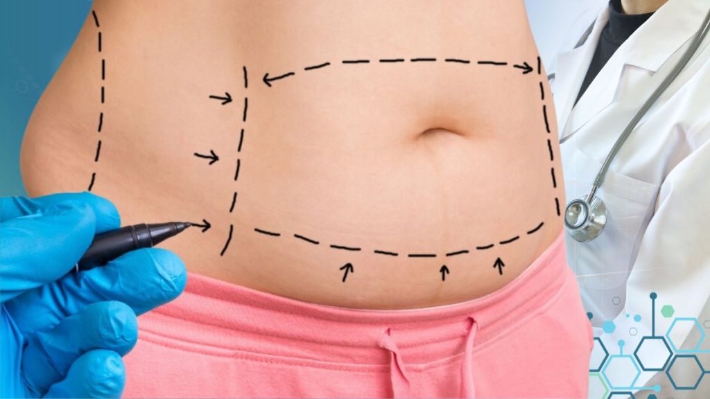 How to Sustain Tummy Tuck Outcomes through Pregnancy