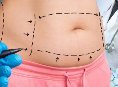 How to Sustain Tummy Tuck Outcomes through Pregnancy