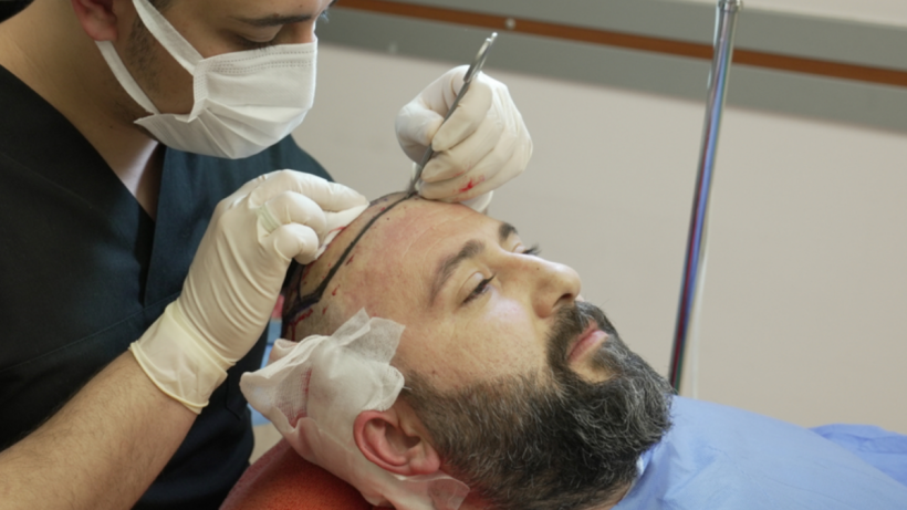 Healing Right Effective Scab Care Post-Hair Transplant