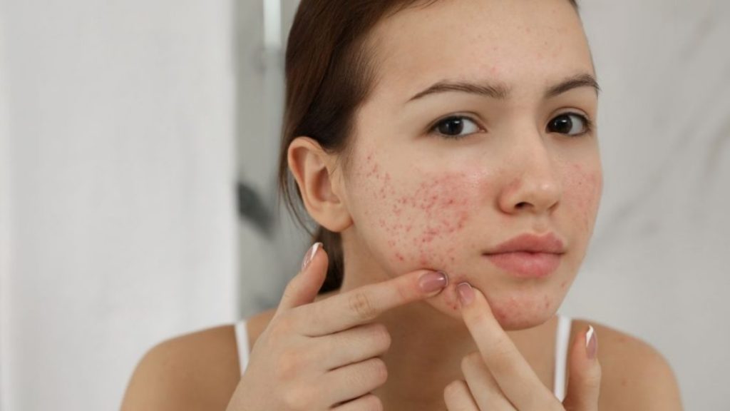 Embracing Your Skin’s Unique Needs Acne Creams for Acne Prone Skin