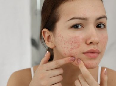 Embracing Your Skin’s Unique Needs Acne Creams for Acne Prone Skin