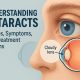 Close-up of an eye showing cloudy lens, illustrating cataract causes and treatment options